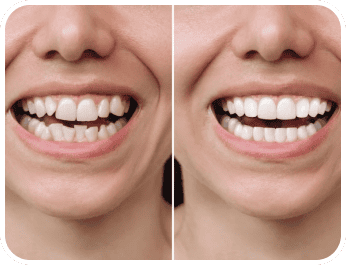 Minimal prep veneers before and after
